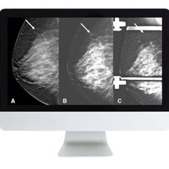 ARRS Breast Imaging: Screening and Diagnosis | Medical Video Courses.