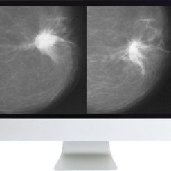 ARRS Harmonizing Breast Cancer Screening Recommendations Hybrid Course 2018 | Medical Video Courses.