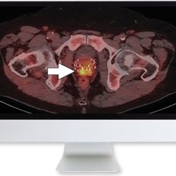 ARRS Molecular Imaging and Therapy of Prostate Cancer 2020 | Medical Video Courses.